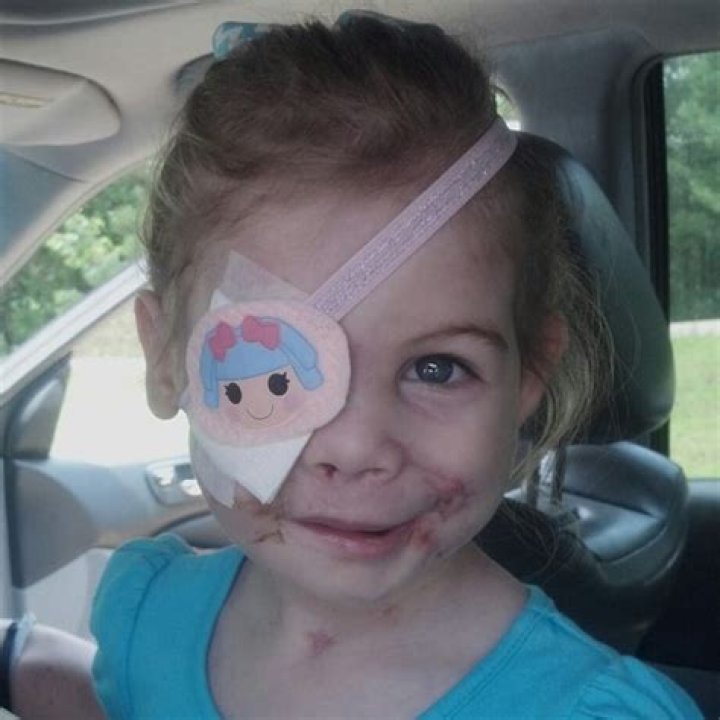 Disfigured Girl, 3, Asked To Leave KFC — Was It A Hoax?