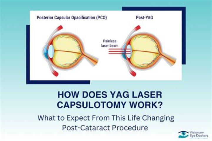 What does YAG capsulotomy stand for?